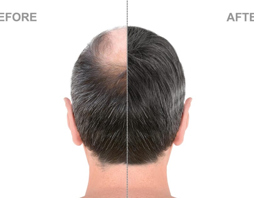 Haartransplantation Istanbul Hair360 — istanbul-haartransplantation-gunstig-810x630