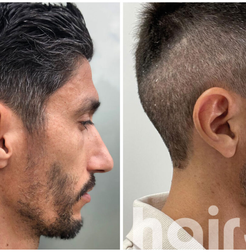 Haartransplantation Istanbul Hair360 — gesichtshaartransplantation-turkei-istanbul-810x830