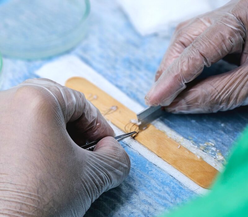 DHI Haartransplantation Ablauf: 7 Schritte vom ersten Gespräch bis zum vollen Haarwuchs
