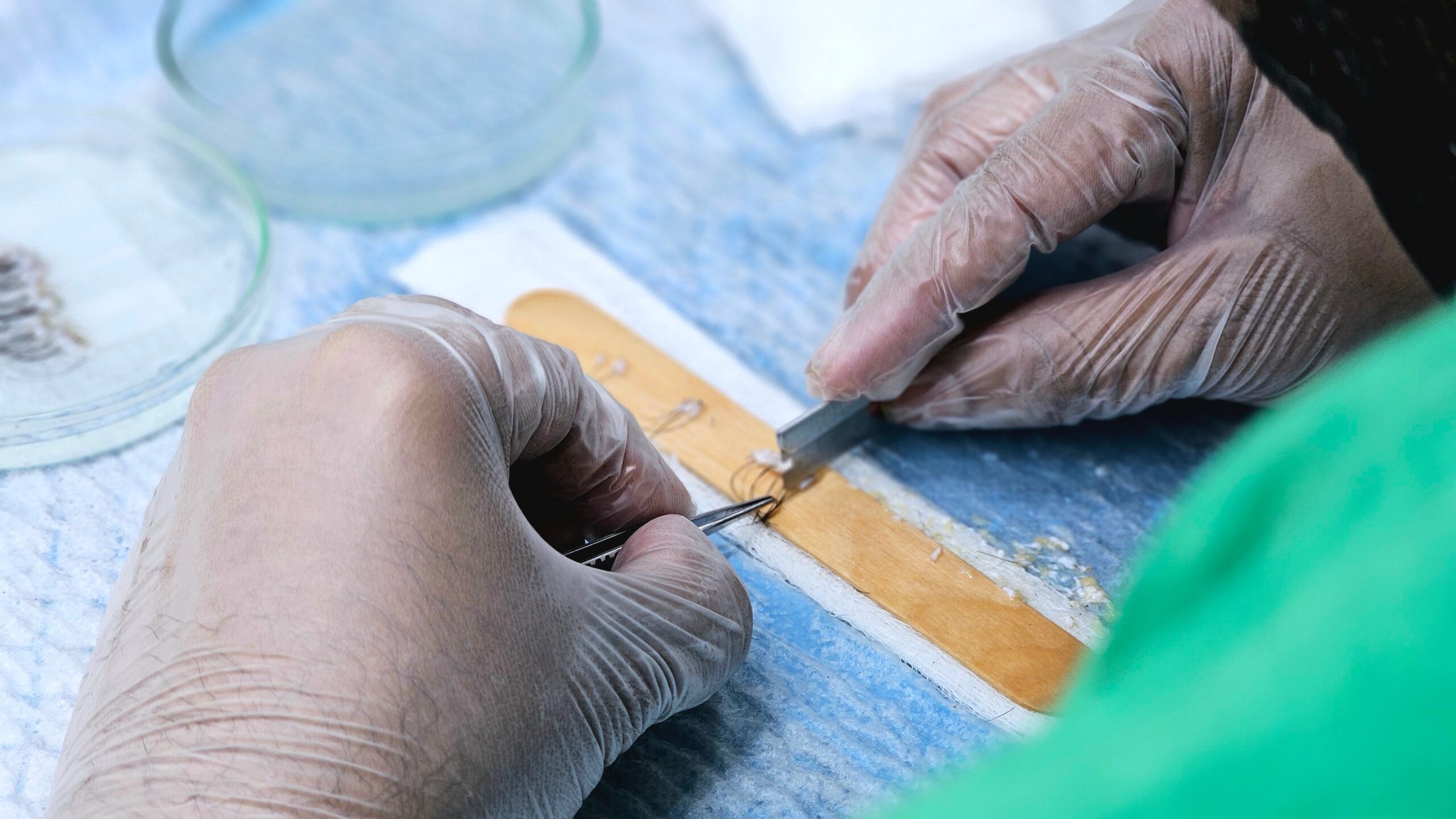 DHI Haartransplantation Ablauf: 7 Schritte vom ersten Gespräch bis zum vollen Haarwuchs