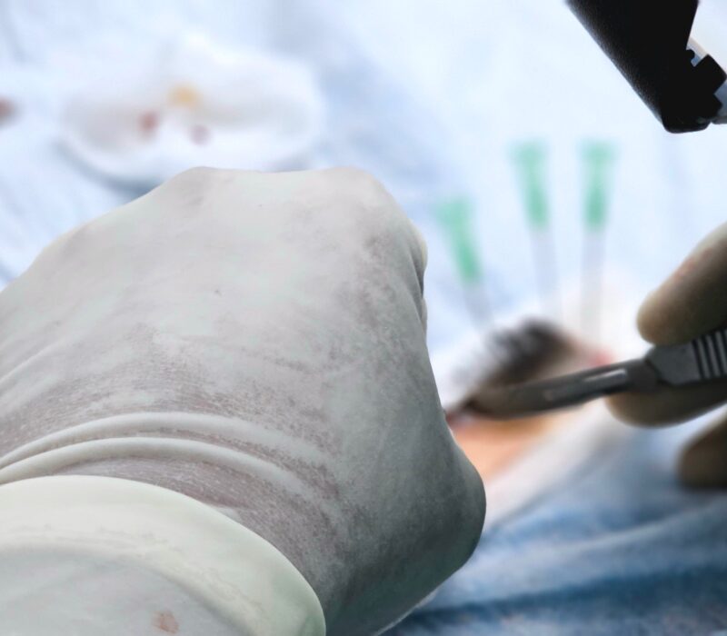 FUE Haartransplantation Methode erklärt