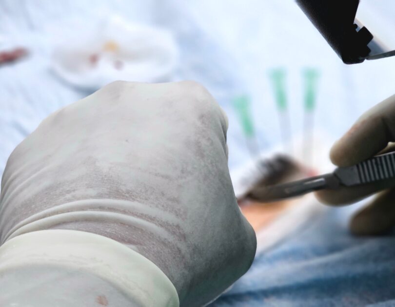 FUE Haartransplantation Methode erklärt